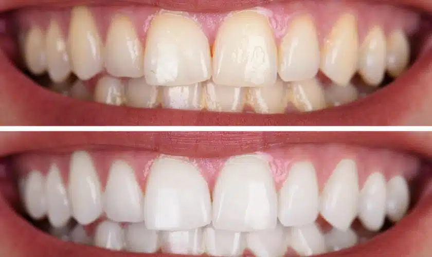 Can You Whiten Your Yellow Teeth Again? BLVD Dentists Answered Your Query